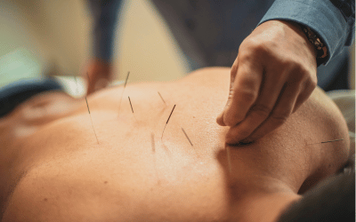 dry needling